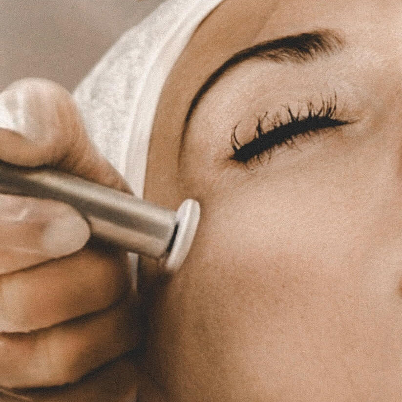 MicroChanneling Facial