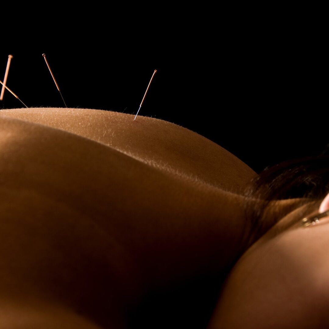 Aura Metier - Acupuncture